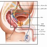 سرطان پروستات
